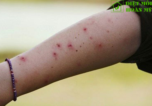 Bị bọ chét cắn phải làm sao?