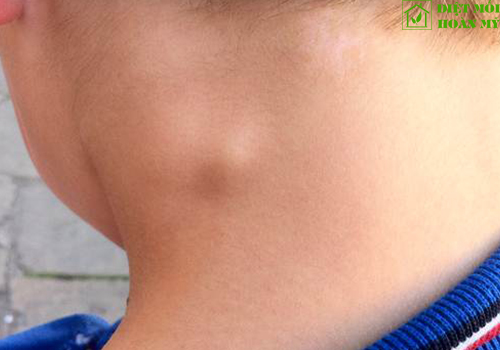 Bệnh dịch hạch ở người