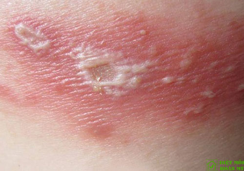 Xử lý kiến ba khoang