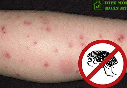 Bọ chét cắn bôi thuốc gì?