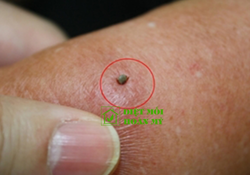 Ve chó có hút máu người không?